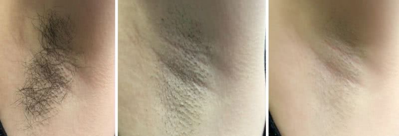 5分钟搞定20多年的毛儿!连小胡子都不见了