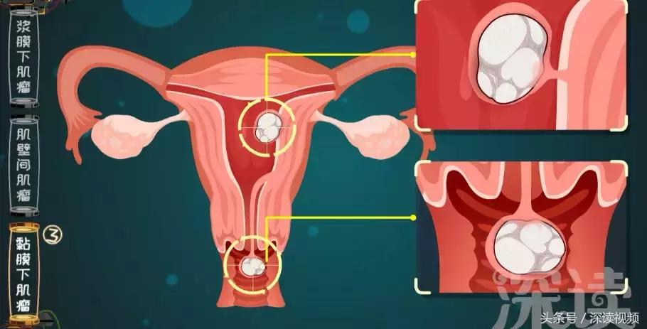 子宫肌瘤在哪个地方影响怀孕,子宫肌瘤剔除怎么还有东西流出来