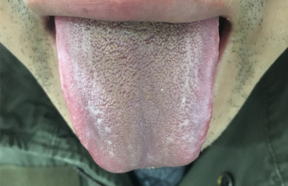 头皮屑过多的中医疗法