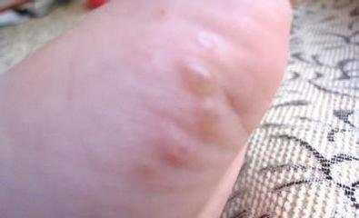 除脚气的简单方法,最简单治脚气的方法