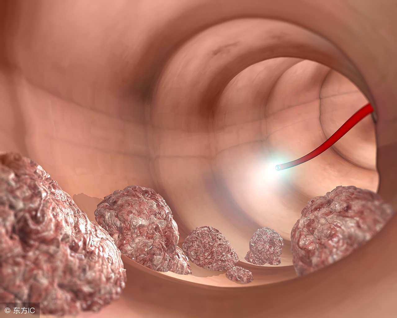 小伙便血以为痔疮结果查出癌晚期,痔疮便血被认定为直肠癌既往症