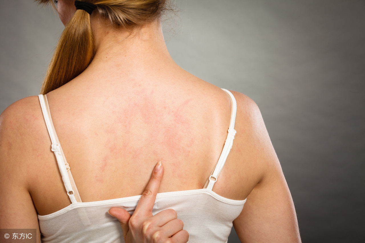 湿疹主要有哪些症状才确定是湿疹,湿疹常见症状有哪些