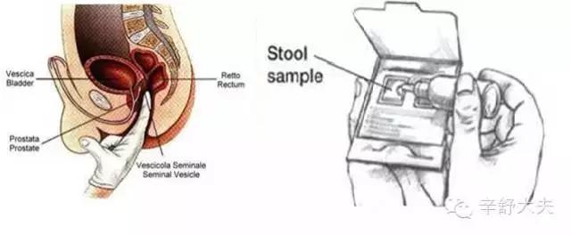 22岁女孩，体检肛门指诊检查，发现“肿物”，原来竟然是这个！