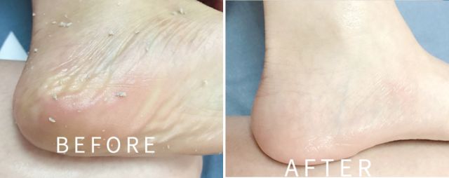 擦掉一张皮，双脚换皮术！死皮、老茧一喷就没，15秒还原嫩白玉足！