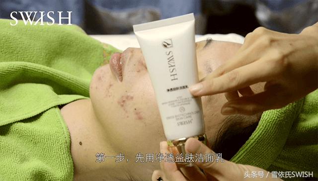 美容院祛痘印的最有效方法,美容院祛痘痘的正确消除方法