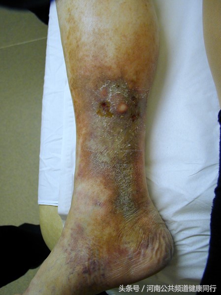 静脉曲张郑大一附院看哪个科,郑大一附院硬化剂治疗静脉曲张