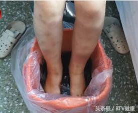 治疗糖尿病足的国医大师,国内中医治疗糖尿病的国医专家