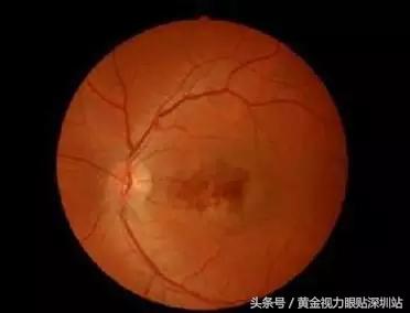 黄斑病变是眼癌吗,致眼盲疾病有哪些