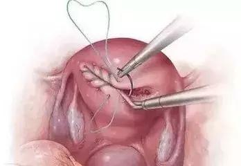 无痛人流真的无痛吗,无痛人流真是一点都不痛吗