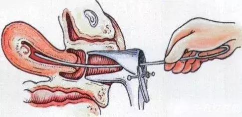 无痛人流真的无痛吗,无痛人流真是一点都不痛吗