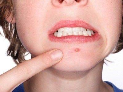 下巴绷紧皮里面有好多颗粒,下巴有白色颗粒凸起怎么解决