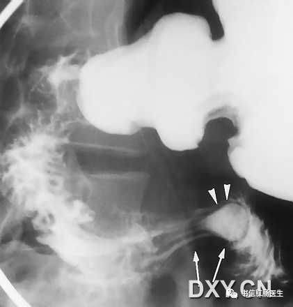 10种经典肠道影像征象：绳征、串珠征、螺纹征……你听过几个？