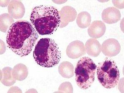 慢性白血病格列卫,慢性粒细胞白血病格列卫