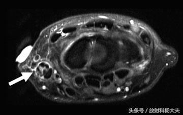 别只关注男足世界杯，看看这个好发于手部的病，女性多于男性