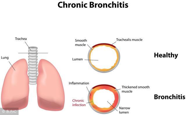 小儿急性支气管炎饮食注意事项,小孩急性支气管炎咳嗽发烧饮食