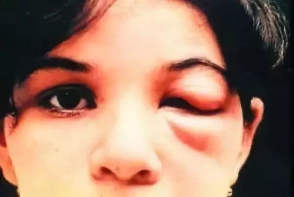 小心“新型艾滋病”，虫子就能传播