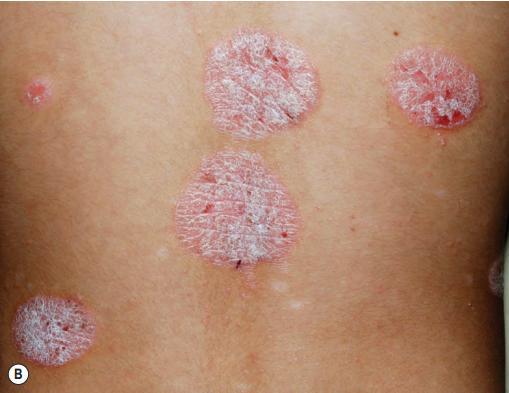 牛皮癣是严重疾病吗,牛皮癣属于什么类疾病