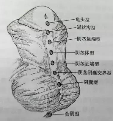 300个男宝就有1个小鸡鸡“开裂”！治不好要像女生蹲着尿