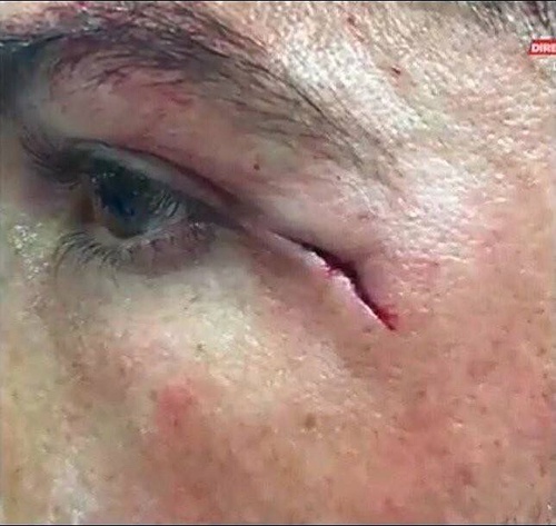 c罗的眼角被撞血流如注,眼角被撞一道口子