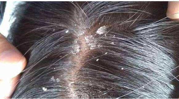 八大妙招轻松告别头皮屑烦恼，让你清爽无屑
