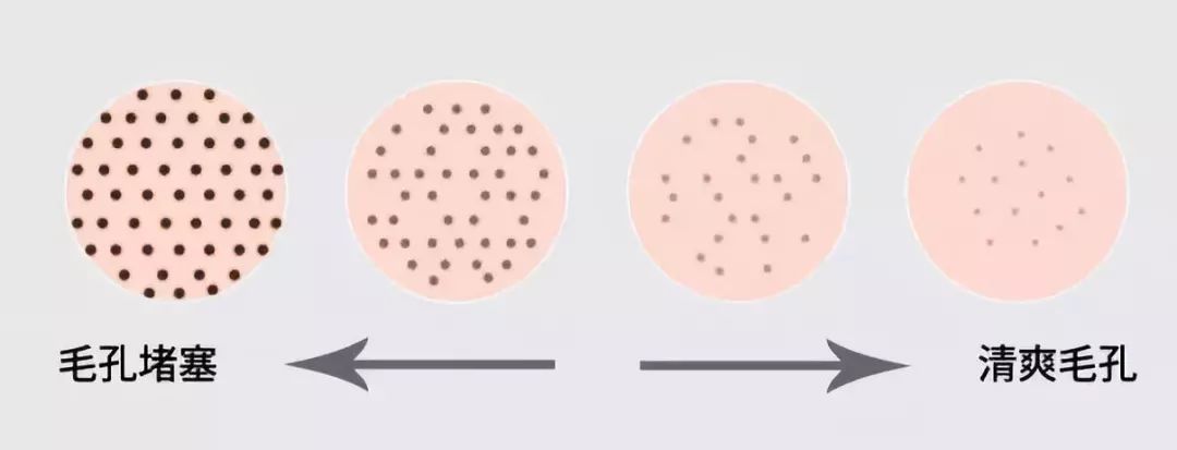 黑头已经有坑了怎么办,有黑头怎么处理方法最有效