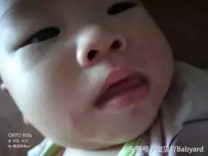 宝宝米粉过敏怎么能好,宝宝米粉过敏该咋办