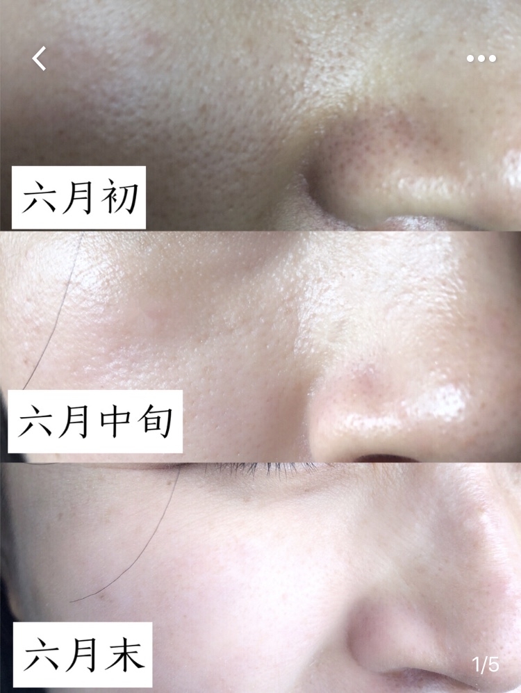 脸上出油多堵塞毛孔粗大白醋洗脸,混油皮收缩毛孔小妙招