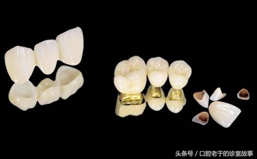 烤瓷冠与全瓷冠价格哪个贵,烤瓷冠多少钱一颗