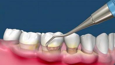 牙周刮治和洗牙有区别吗,洗牙一个月后做牙周刮治可以吗