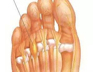 女孩脚肿瘤,25岁女性脚趾长肿瘤