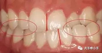 牙齿不齐矫正好还是做牙冠好,牙齿不齐矫正1个月的变化