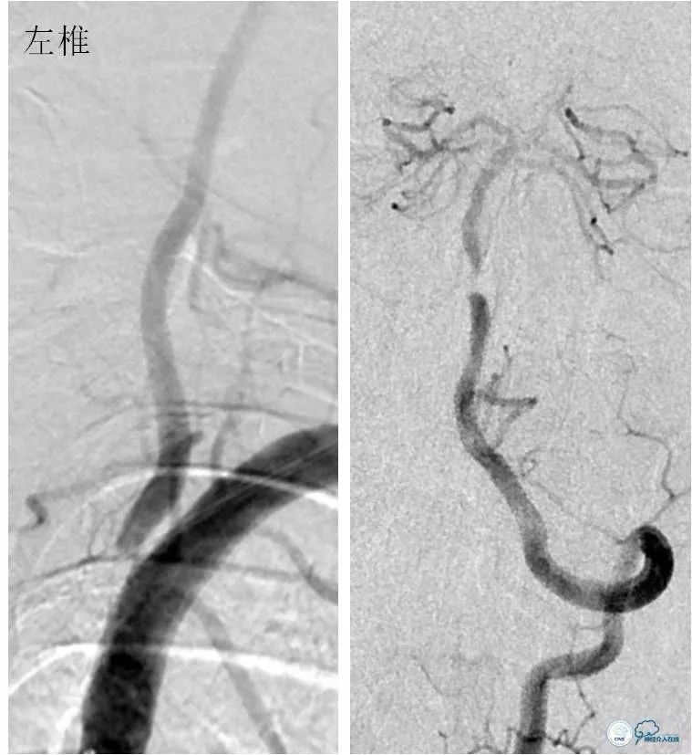 天坛周记｜左椎动脉开口及基底动脉串联狭窄血管内介入治疗1例
