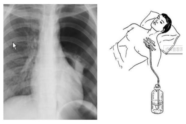穿刺股动脉并发症,穿刺部位并发症预防及处理