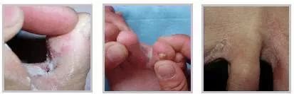 怎么才可以拯救汗脚,如何拯救脚臭