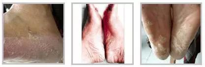 怎么拯救你,我的“大汗脚”……脚臭和脚气,有多远的距离?