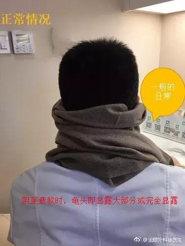 怎么判断自己的包皮需不需要割,如何判断包皮到底需不需要割