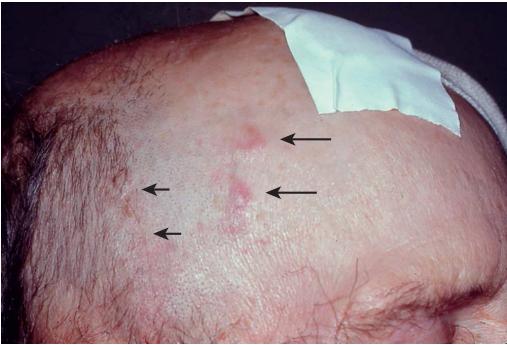 老年不明原因发热,老年人无症状发烧是怎么回事