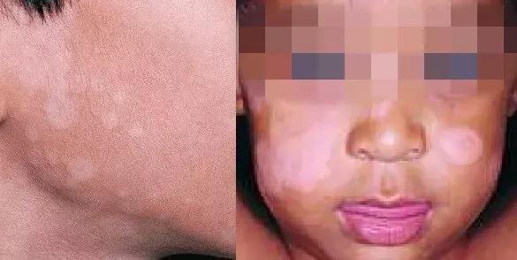 儿童脸上长白斑是什么原因引起,儿童脸上长白斑缺什么微量元素