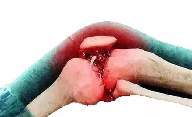 关节炎？走路痛？洋葱这样用，“赶”走膝盖痛！快学起来~