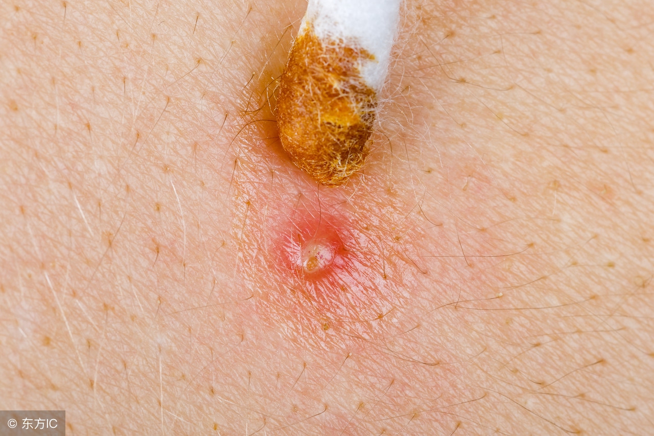 毛囊炎是什么细菌感染引起的,毛囊炎主要感染菌群是化脓菌吗