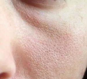 治疗毛孔粗大,激光治疗毛孔粗大多少钱