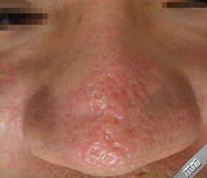 治疗毛孔粗大,激光治疗毛孔粗大多少钱