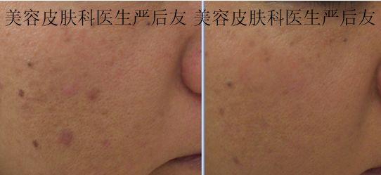 治疗毛孔粗大,激光治疗毛孔粗大多少钱