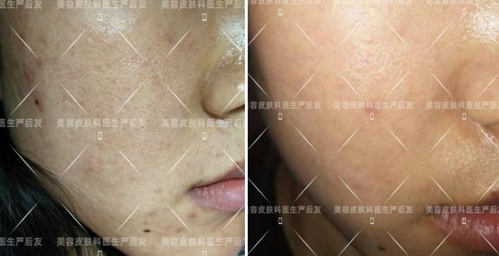 毛孔粗大如何治疗最好最快,如何治疗黑头和毛孔粗大