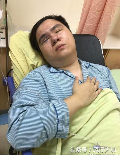 玻尿酸隆鼻的网红,因打玻尿酸毁容的男网红