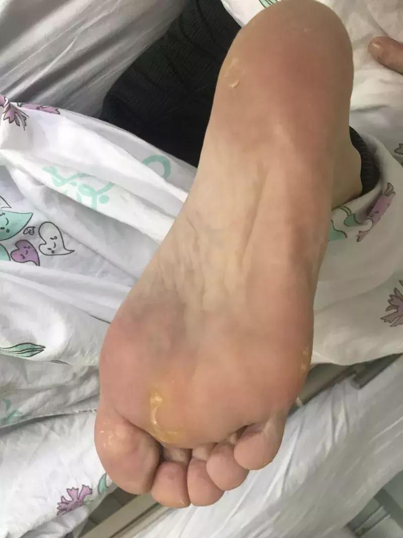 化疗后烂手烂脚怎么办,化疗手脚皮肤溃烂如何处理