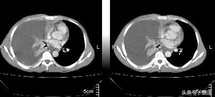 结核性胸膜炎能不能根治,结核性胸膜炎怎么导致的