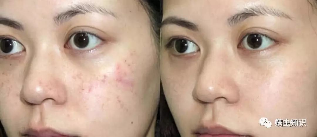 换季脸上长痘,换季脸上长痘痒怎么办