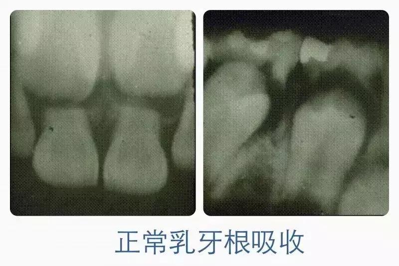 乳牙拔出后牙根却不完整,乳牙拔掉了新牙迟迟不出
