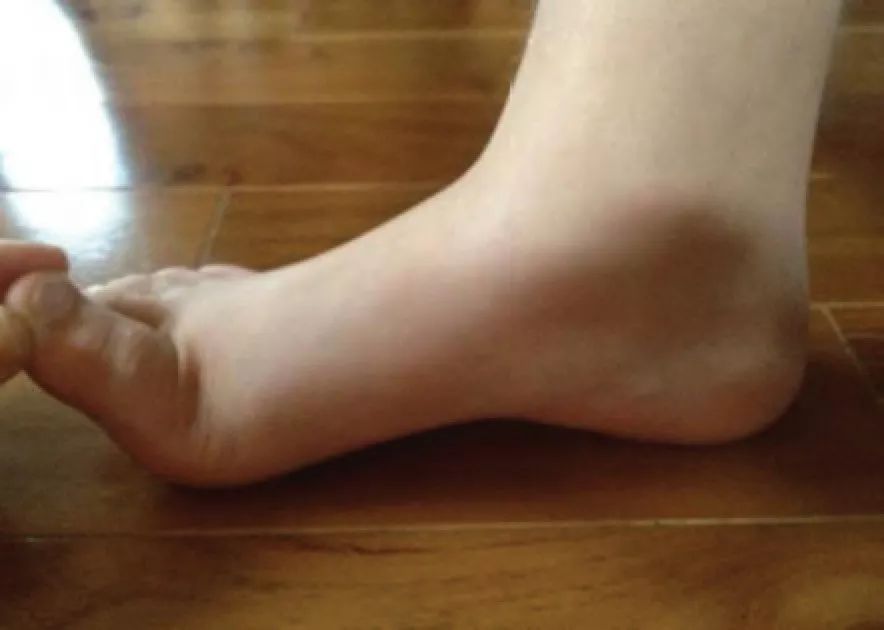 儿童扁平足矫正方法,儿童扁平足不治疗会怎么样